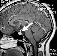 Meningioma Image