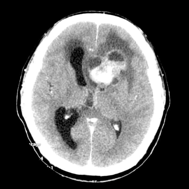 Meningioma Image