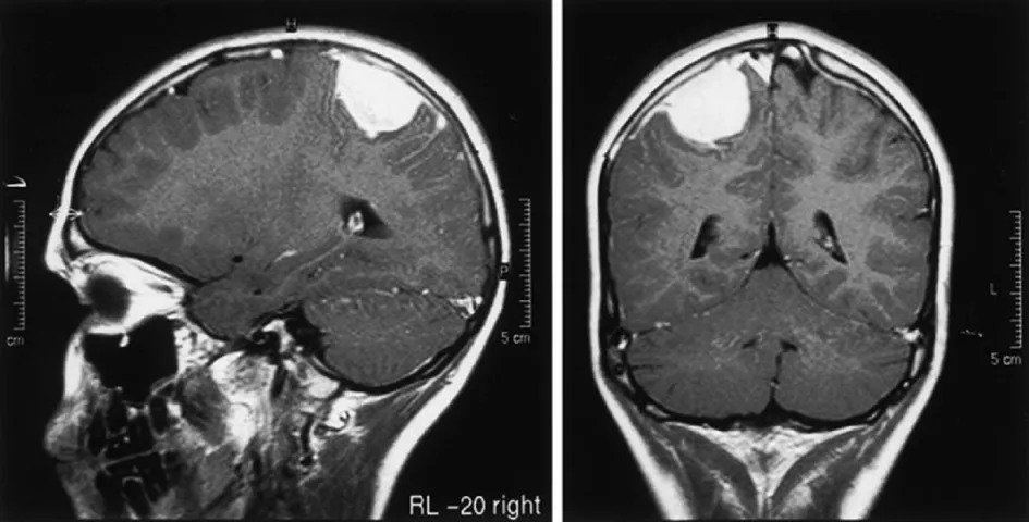 Meningioma Image