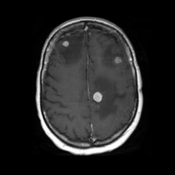 Meningioma Image