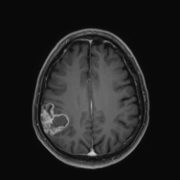 Meningioma Image