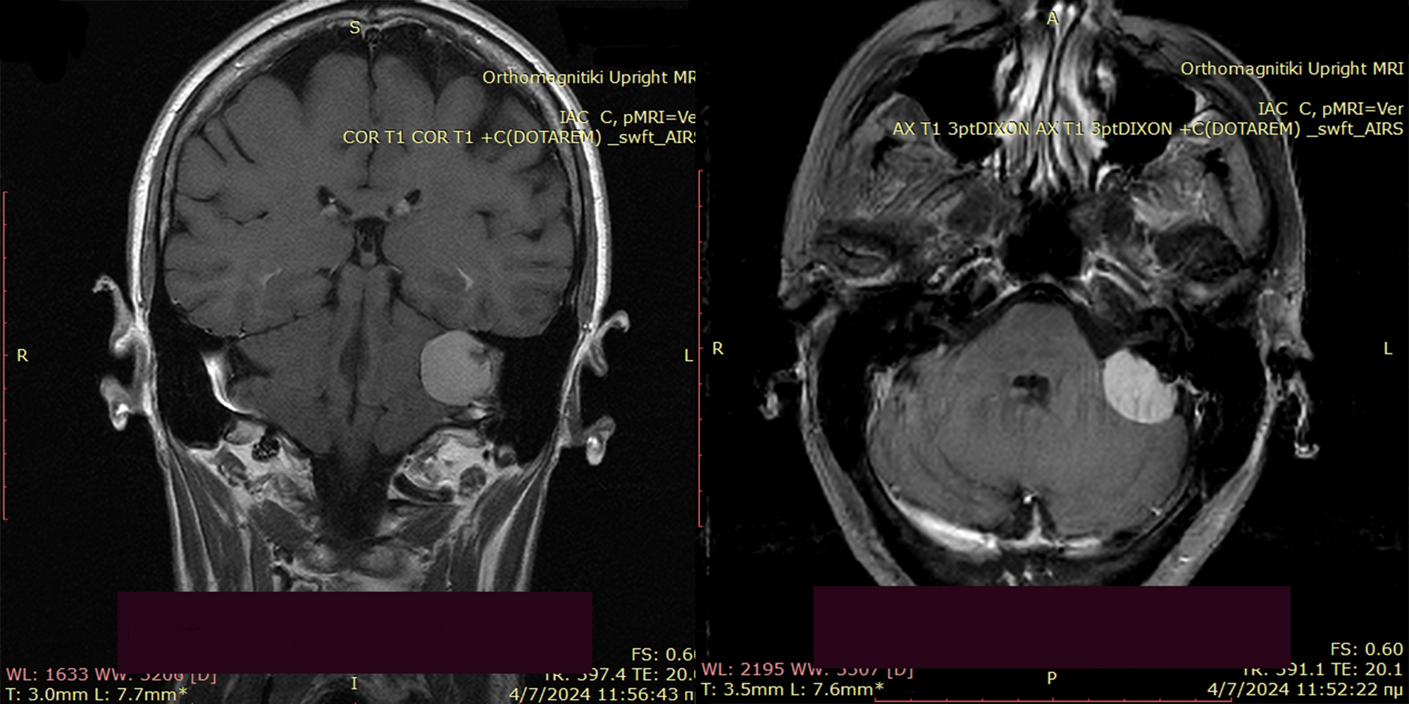 Meningioma Image