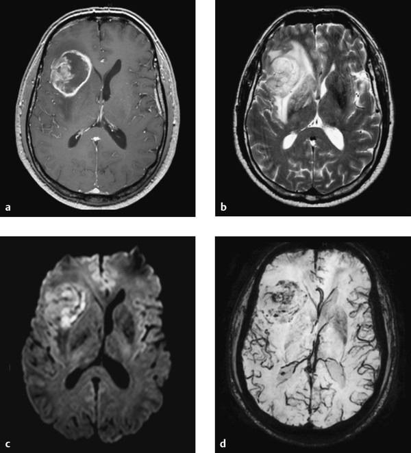 Meningioma Image